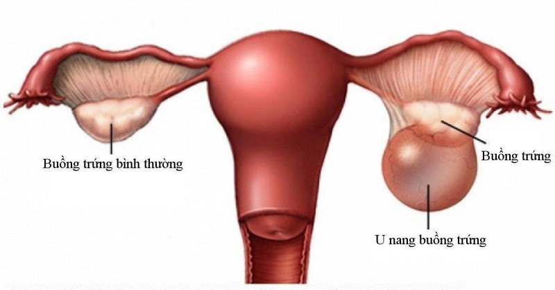 Trò chuyện cùng Doctor Light – U nang buồng trứng