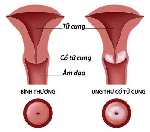 Ung thư  tử cung là gì và các dấu hiệu ung thư ngoài tử cung?